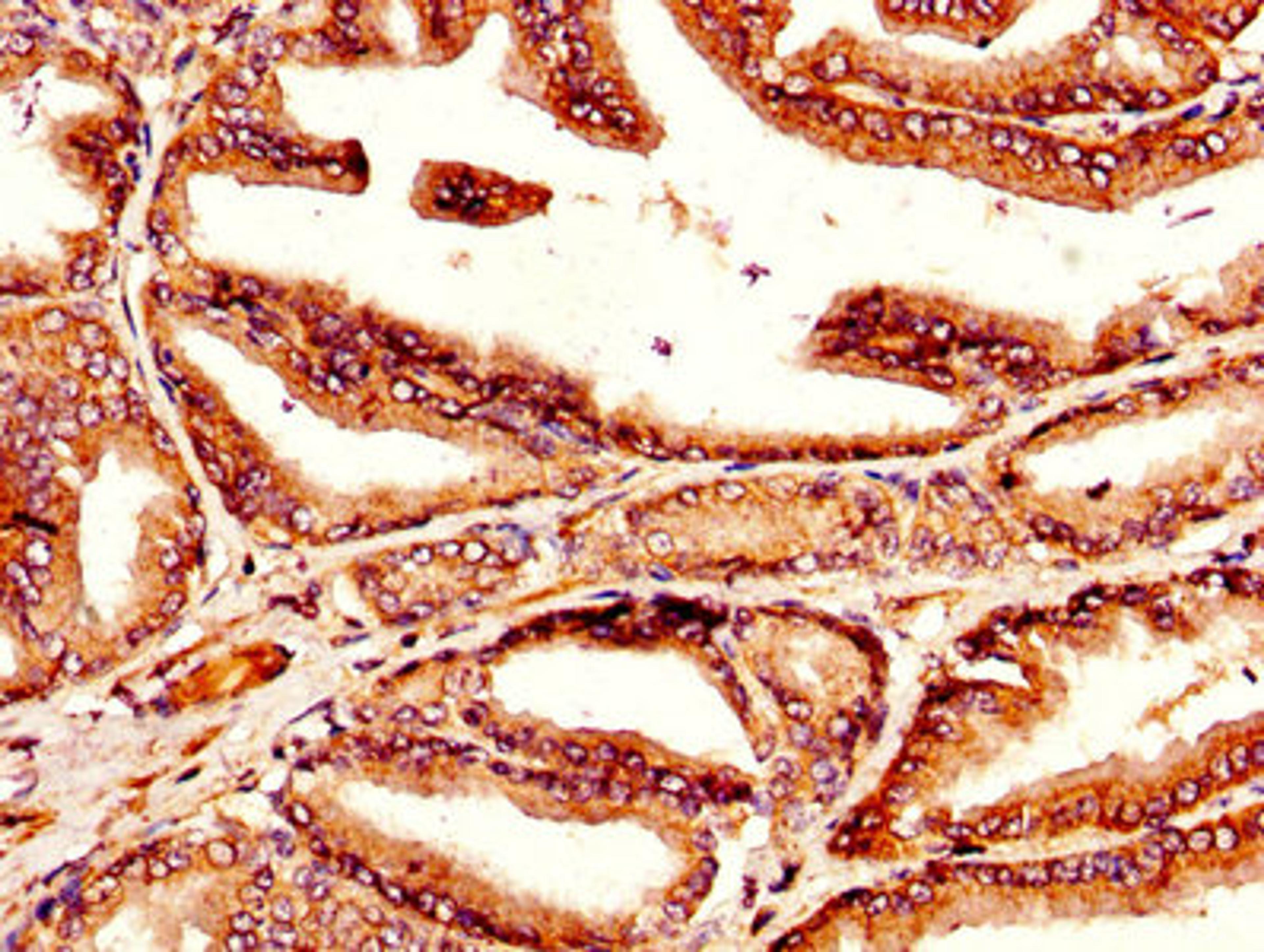 IHC image of CSB-PA023464LA01HU diluted at 1:300 and staining in paraffin-embedded human prostate tissue performed on a Leica BondTM system. After dewaxing and hydration, antigen retrieval was mediated by high pressure in a citrate buffer (pH 6.0). Section was blocked with 10% normal goat serum 30min at RT. Then primary antibody (1% BSA) was incubated at 4&deg;C overnight. The primary is detected by a biotinylated secondary antibody and visualized using an HRP conjugated SP system.