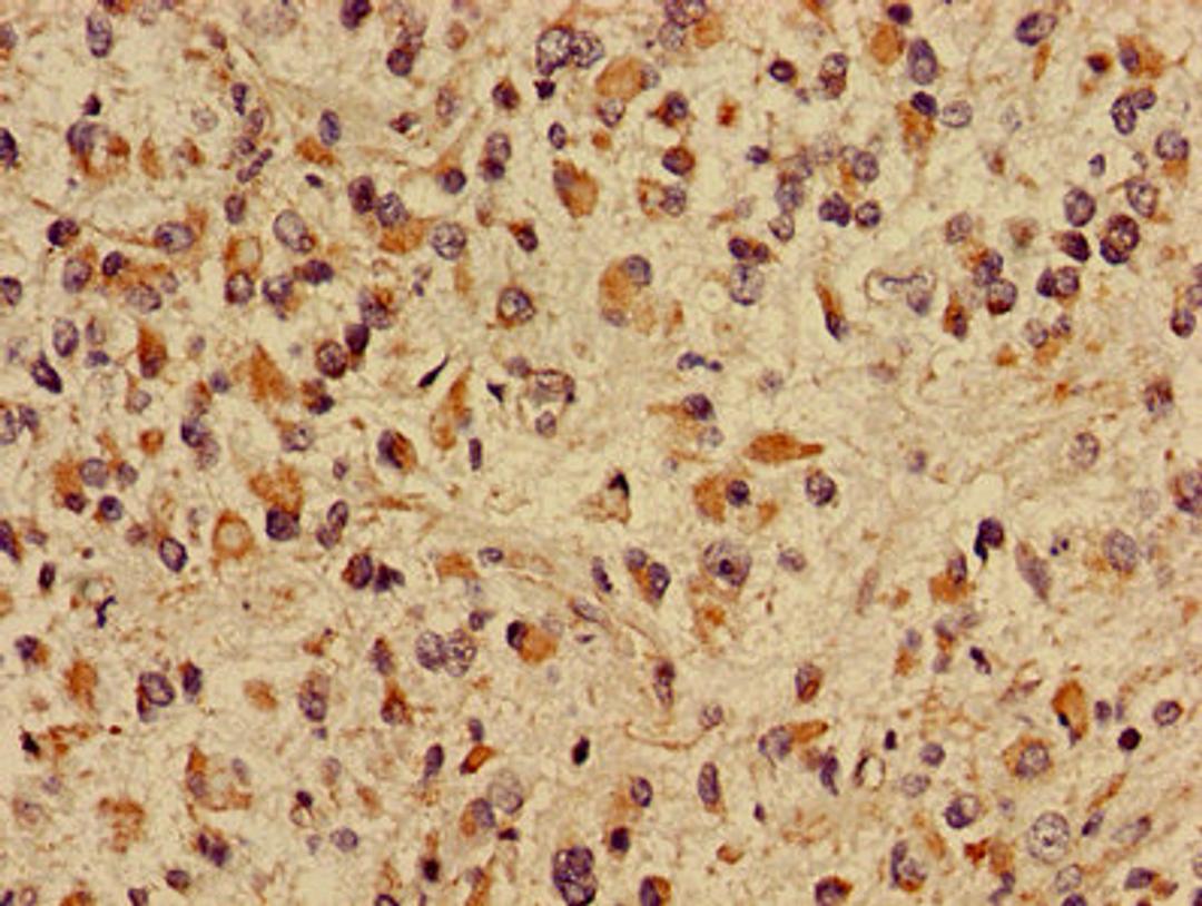 Immunohistochemistry of paraffin-embedded human glioma using CSB-PA005973LA01HU at dilution of 1:100