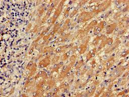 Immunohistochemistry of paraffin-embedded human liver cancer using CSB-PA024106LA01HU at dilution of 1:100