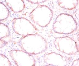 Immunohistochemistry of paraffin-embedded human colon cancer using CSB-PA00254A0Rb at dilution of 1:50