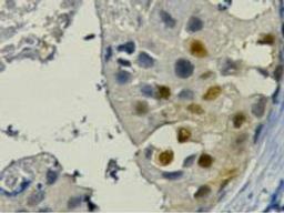 IHC staining of Human breast cancer tissue paraffin-embedded, diluted at 1:200