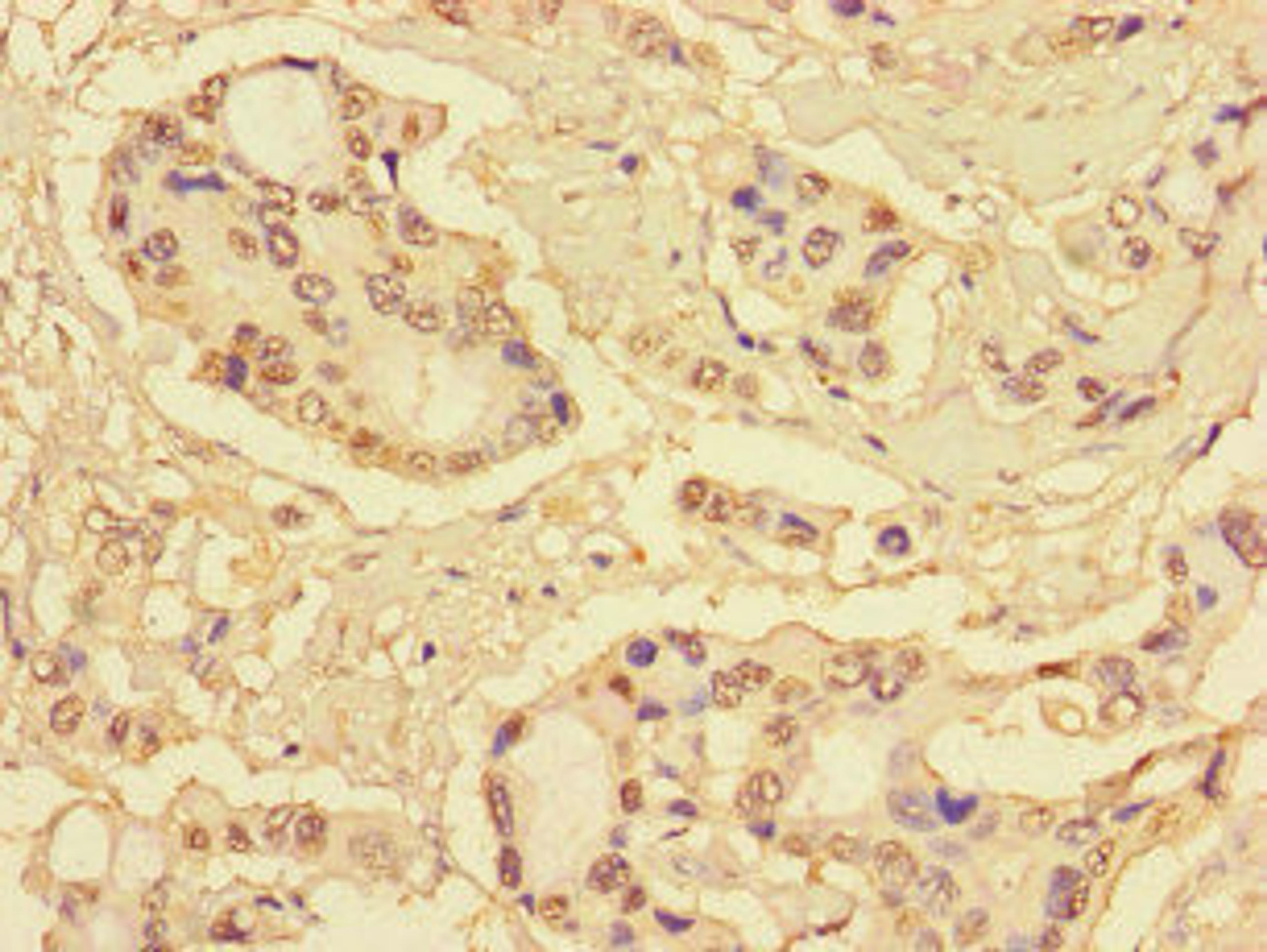Immunohistochemistry of paraffin-embedded human pancreatic cancer using CSB-PA020645LA01HU at dilution of 1:100