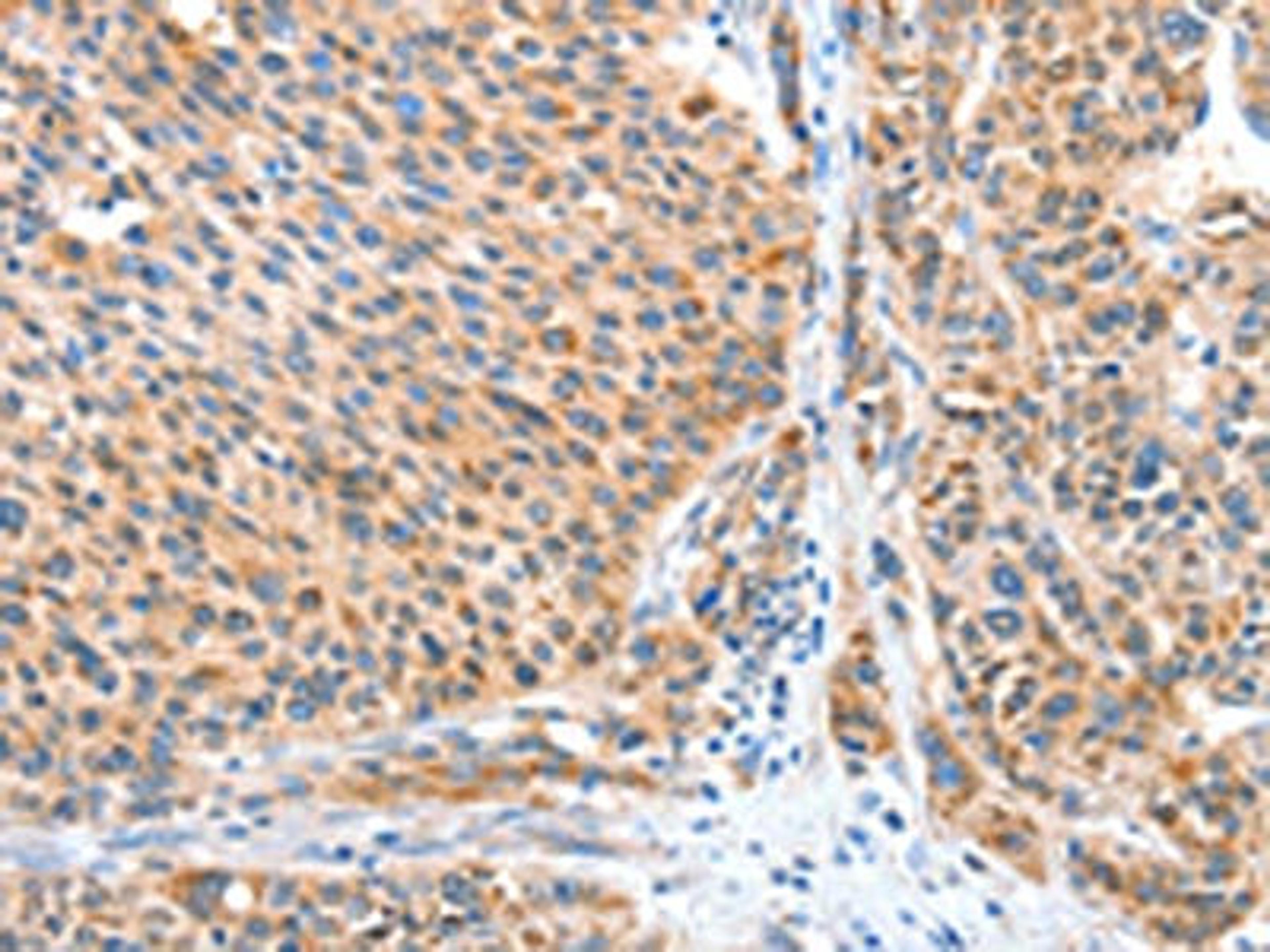 The image on the left is immunohistochemistry of paraffin-embedded Human liver cancer tissue using CSB-PA505238(CASP7 Antibody) at dilution 1/20, on the right is treated with fusion protein. (Original magnification: X200)