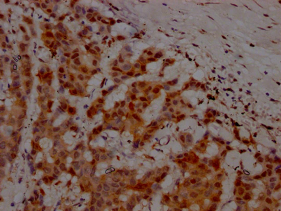 IHC image of CSB-RA166706A0HU diluted at 1:100 and staining in paraffin-embedded human breast cancer performed on a Leica BondTM system. After dewaxing and hydration, antigen retrieval was mediated by high pressure in a citrate buffer (pH 6.0). Section was blocked with 10% normal goat serum 30min at RT. Then primary antibody (1% BSA) was incubated at 4℃ overnight. The primary is detected by a Goat anti-rabbit IgG polymer labeled by HRP and visualized using 0.05% DAB.