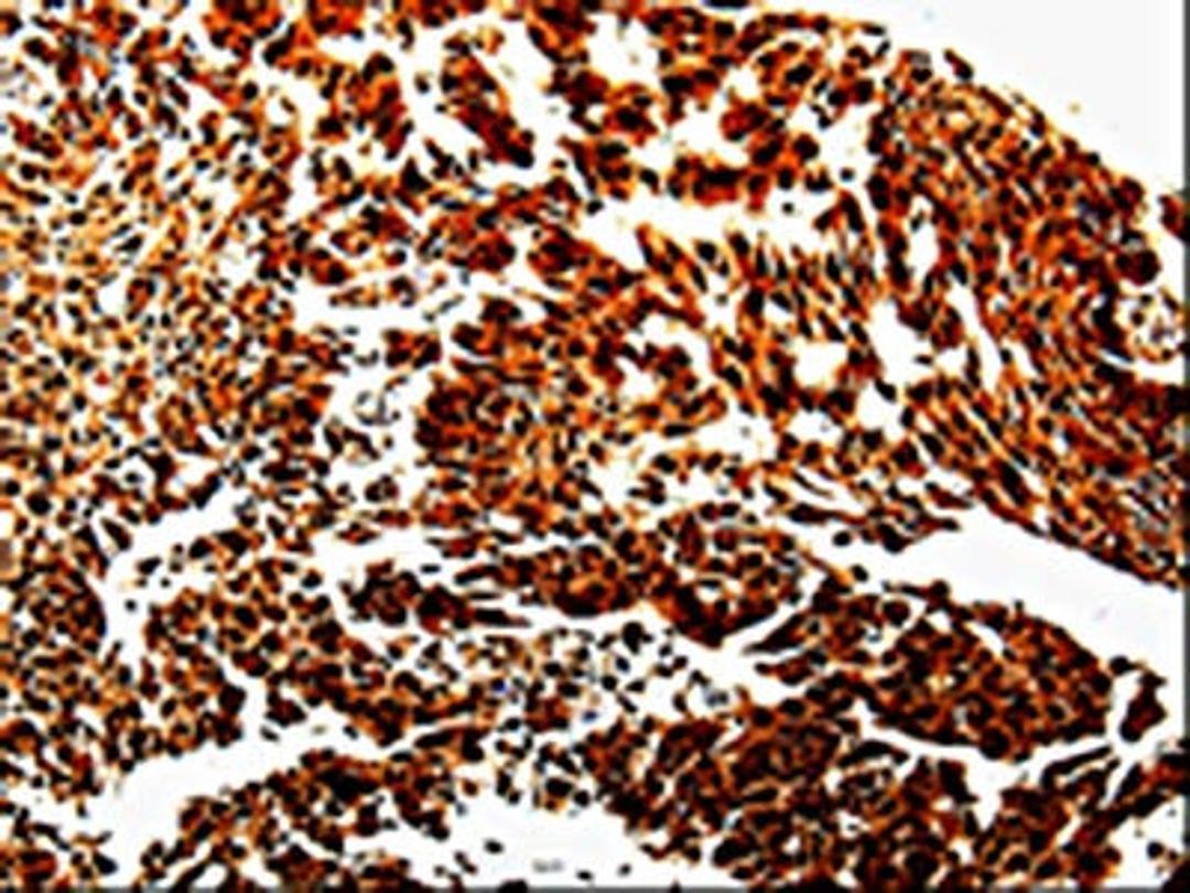 The image is immunohistochemistry of paraffin-embedded Human liver cancer tissue using CSB-PA797584(MMP13 Antibody) at dilution 1/10. (Original magnification: ×200)