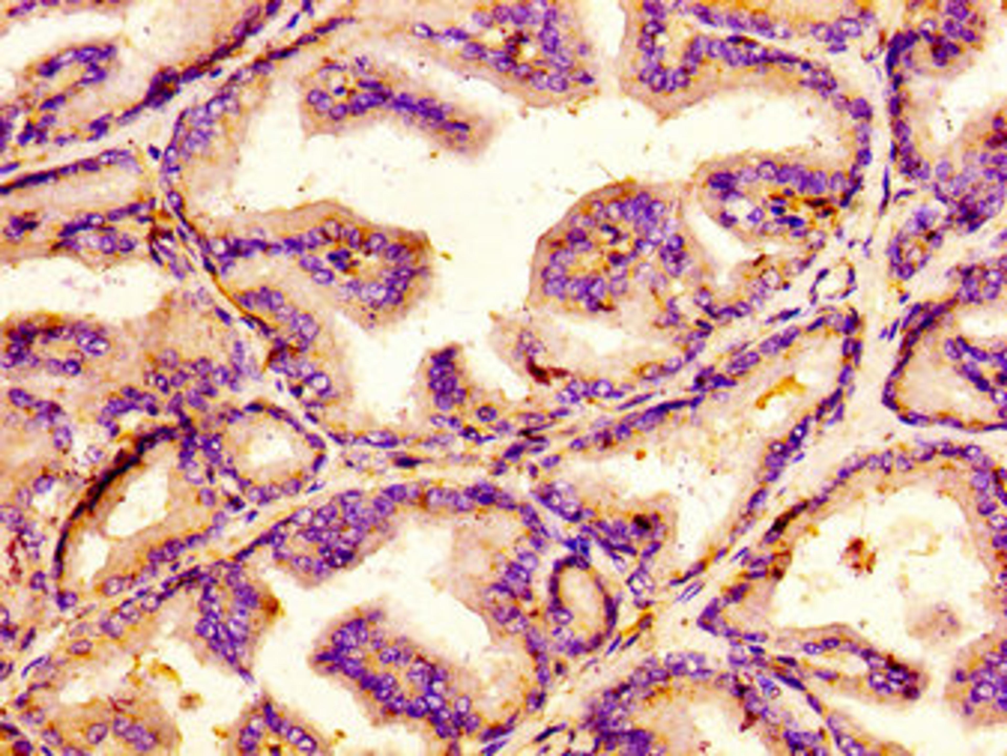 IHC image of CSB-PA850838LA01HU diluted at 1:100 and staining in paraffin-embedded human prostate tissue performed on a Leica BondTM system. After dewaxing and hydration, antigen retrieval was mediated by high pressure in a citrate buffer (pH 6.0). Section was blocked with 10% normal goat serum 30min at RT. Then primary antibody (1% BSA) was incubated at 4&deg;C overnight. The primary is detected by a biotinylated secondary antibody and visualized using an HRP conjugated SP system.