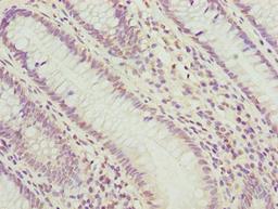 Immunohistochemistry of paraffin-embedded human colon cancer using CSB-PA018193LA01HU at dilution of 1:100