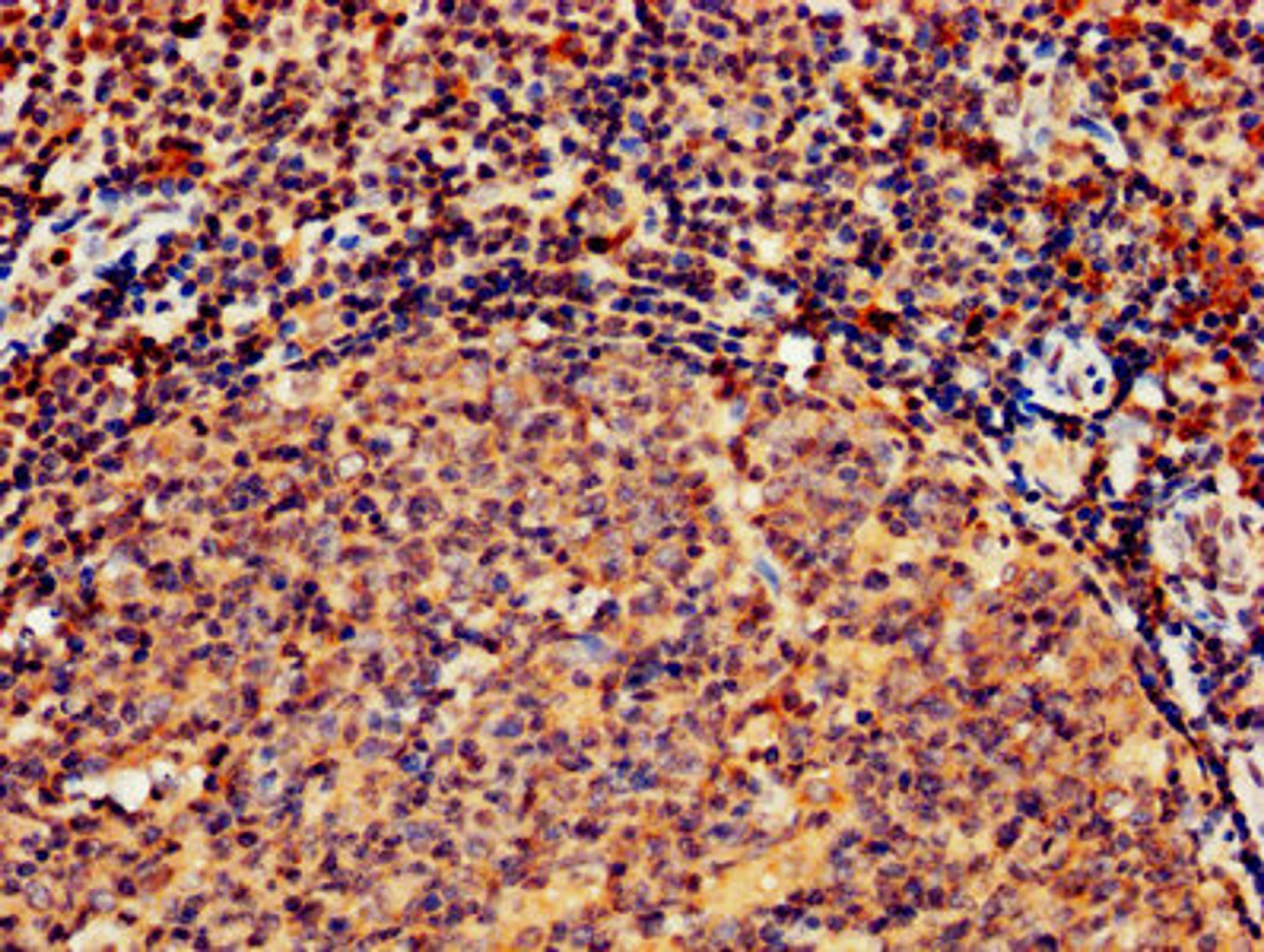IHC image of CSB-PA010082LA01HU diluted at 1:800 and staining in paraffin-embedded human tonsil tissue performed on a Leica BondTM system. After dewaxing and hydration, antigen retrieval was mediated by high pressure in a citrate buffer (pH 6.0). Section was blocked with 10% normal goat serum 30min at RT. Then primary antibody (1% BSA) was incubated at 4&deg;C overnight. The primary is detected by a biotinylated secondary antibody and visualized using an HRP conjugated SP system.