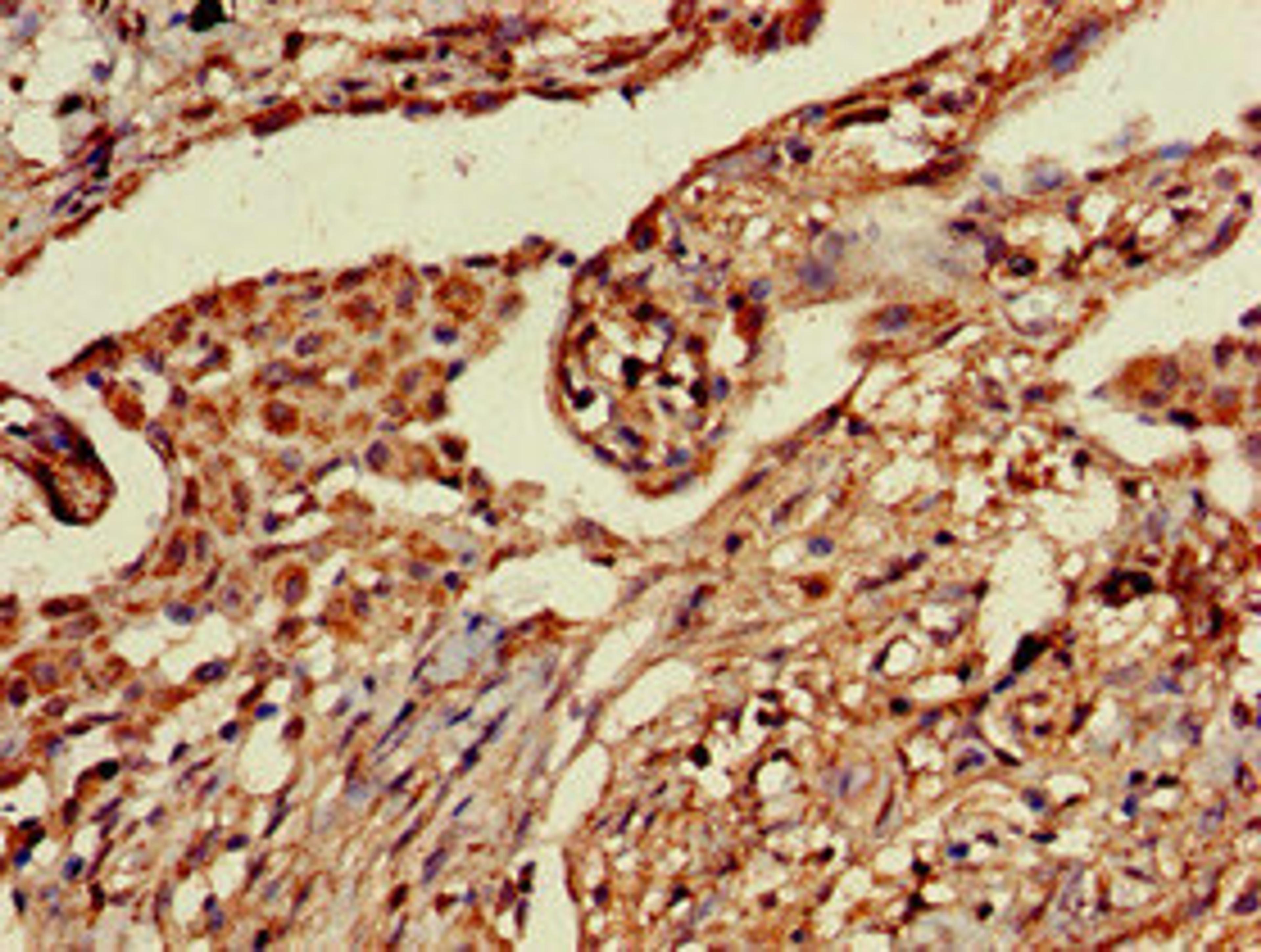 Immunohistochemistry of paraffin-embedded human lung cancer using CSB-PA836225LA01HU at dilution of 1:100