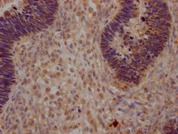 IHC image of CSB-PA026244LA01HU diluted at 1:200 and staining in paraffin-embedded human ovarian cancer performed on a Leica BondTM system. After dewaxing and hydration, antigen retrieval was mediated by high pressure in a citrate buffer (pH 6.0). Section was blocked with 10% normal goat serum 30min at RT. Then primary antibody (1% BSA) was incubated at 4°C overnight. The primary is detected by a Goat anti-rabbit polymer IgG labeled by HRP and visualized using 0.05% DAB.