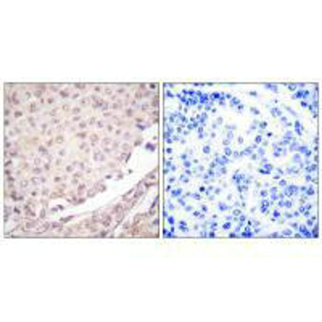 Immunohistochemical analysis of paraffin-embedded human lung carcinoma tissue using Cullin 1 antibody.