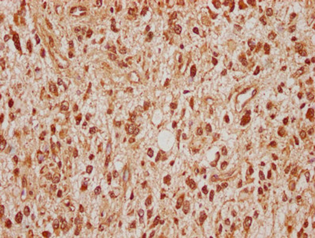 IHC image of CSB-PA022683LA01HU diluted at 1:100 and staining in paraffin-embedded human glioma cancer performed on a Leica BondTM system. After dewaxing and hydration, antigen retrieval was mediated by high pressure in a citrate buffer (pH 6.0). Section was blocked with 10% normal goat serum 30min at RT. Then primary antibody (1% BSA) was incubated at 4°C overnight. The primary is detected by a biotinylated secondary antibody and visualized using an HRP conjugated SP system.