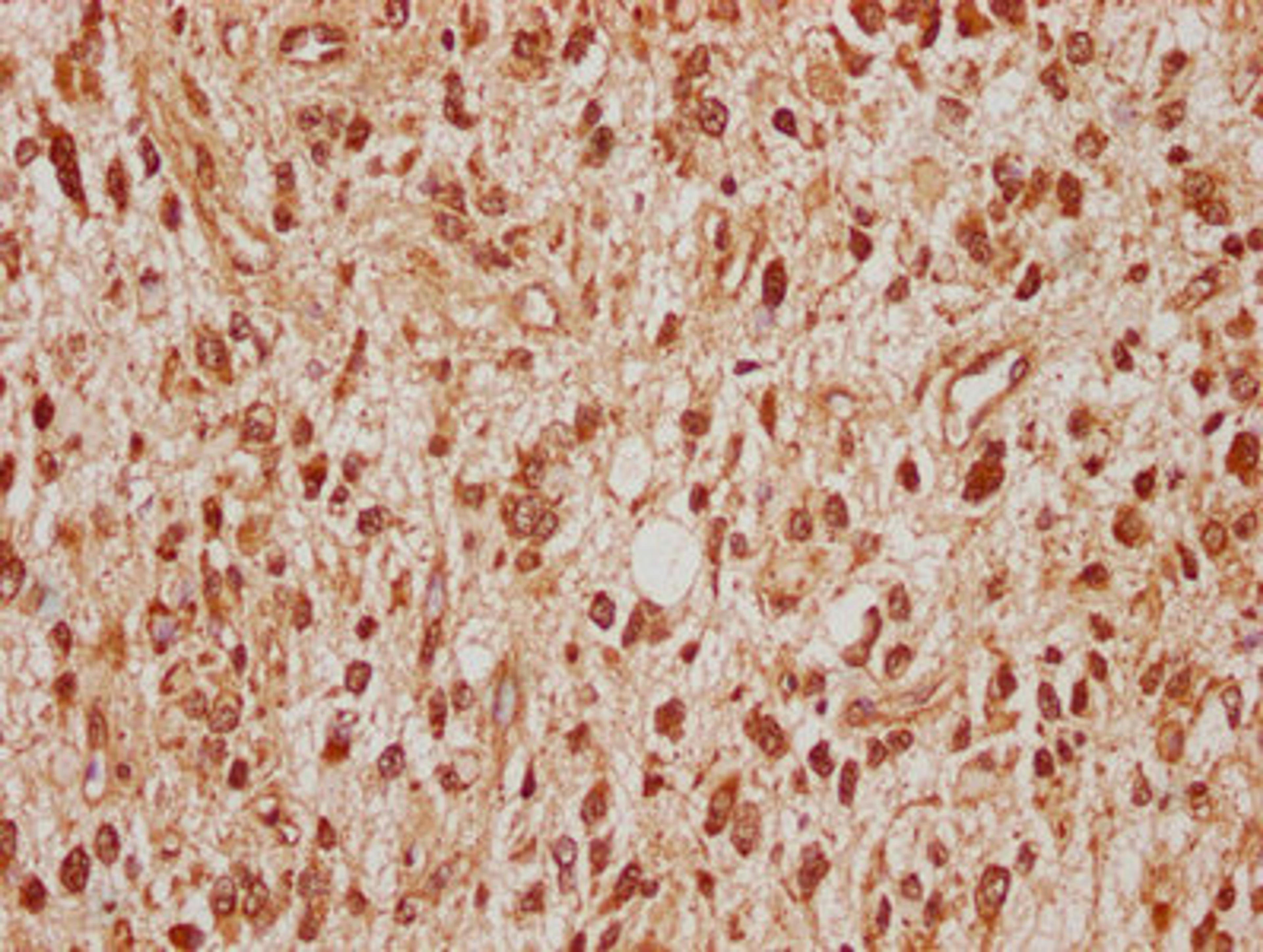 IHC image of CSB-PA022683LA01HU diluted at 1:100 and staining in paraffin-embedded human glioma cancer performed on a Leica BondTM system. After dewaxing and hydration, antigen retrieval was mediated by high pressure in a citrate buffer (pH 6.0). Section was blocked with 10% normal goat serum 30min at RT. Then primary antibody (1% BSA) was incubated at 4°C overnight. The primary is detected by a biotinylated secondary antibody and visualized using an HRP conjugated SP system.