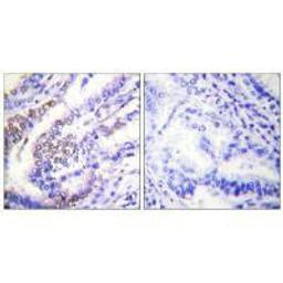 Immunohistochemical analysis of paraffin-embedded human lung carcinoma tissue using Cyclin E1 antibody.