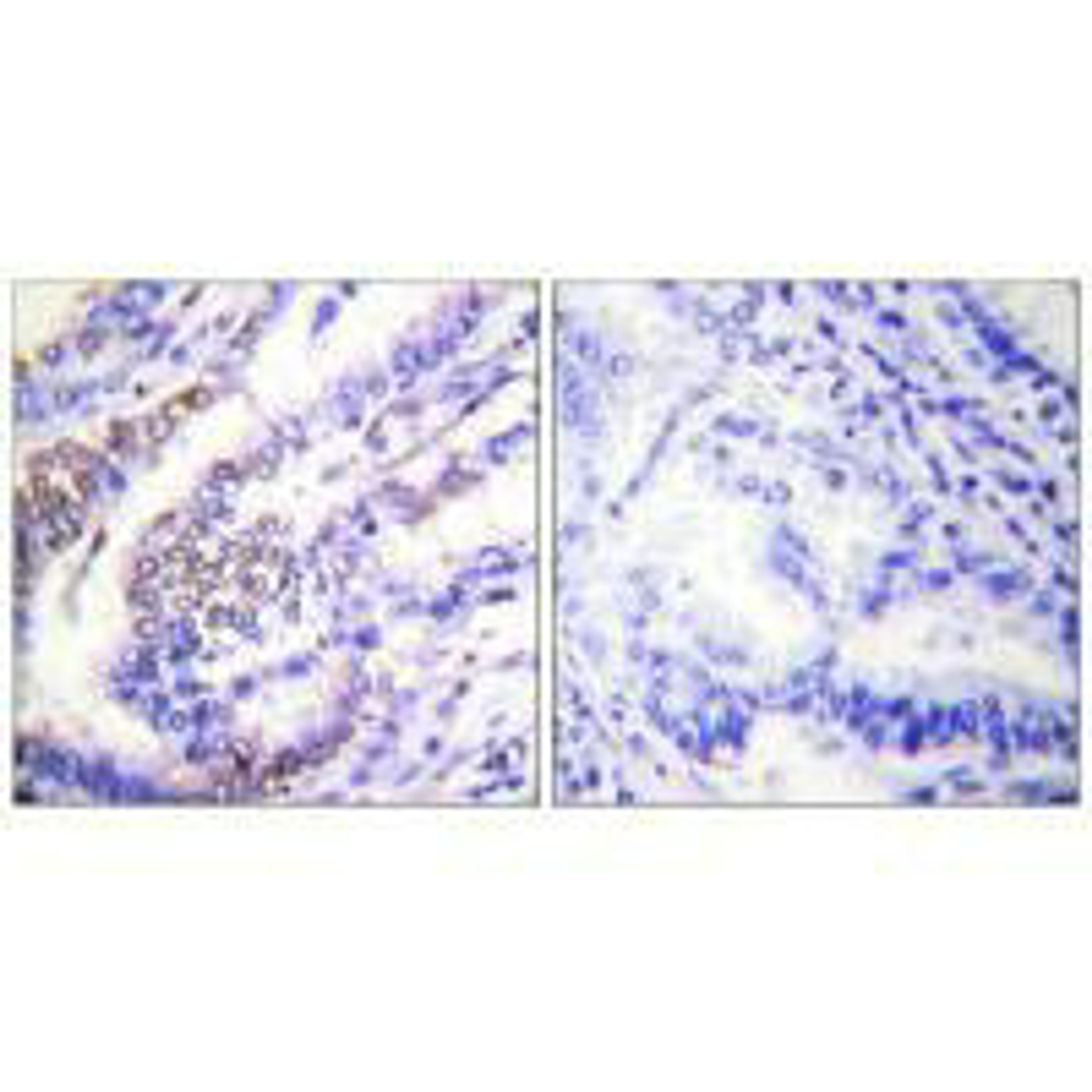 Immunohistochemical analysis of paraffin-embedded human lung carcinoma tissue using Cyclin E1 antibody.