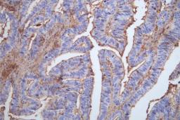 IHC image of CSB-RA293053A0HU diluted at 1:100 and staining in paraffin-embedded human colon cancer performed on a Leica BondTM system. After dewaxing and hydration, antigen retrieval was mediated by high pressure in a citrate buffer (pH 6.0). Section was blocked with 10% normal goat serum 30min at RT. Then primary antibody (1% BSA) was incubated at 4°C overnight. The primary is detected by a Goat anti-rabbit polymer IgG labeled by HRP and visualized using 0.05% DAB.