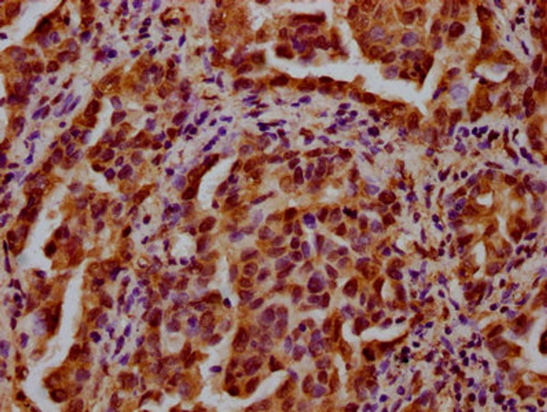 IHC image of CSB-PA010418OA27nbhbHU diluted at 1:20 and staining in paraffin-embedded human lung cancer performed on a Leica BondTM system. After dewaxing and hydration, antigen retrieval was mediated by high pressure in a citrate buffer (pH 6.0). Section was blocked with 10% normal goat serum 30min at RT. Then primary antibody (1% BSA) was incubated at 4&deg;C overnight. The primary is detected by a biotinylated secondary antibody and visualized using an HRP conjugated SP system.