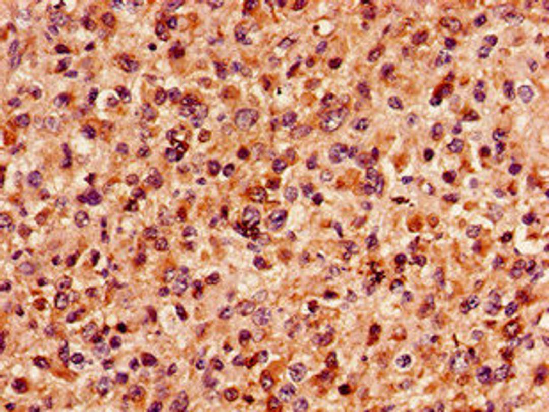 Immunohistochemistry of paraffin-embedded human glioma using CSB-PA013435LA01HU at dilution of 1:100