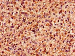 Immunohistochemistry of paraffin-embedded human glioma using CSB-PA013435LA01HU at dilution of 1:100