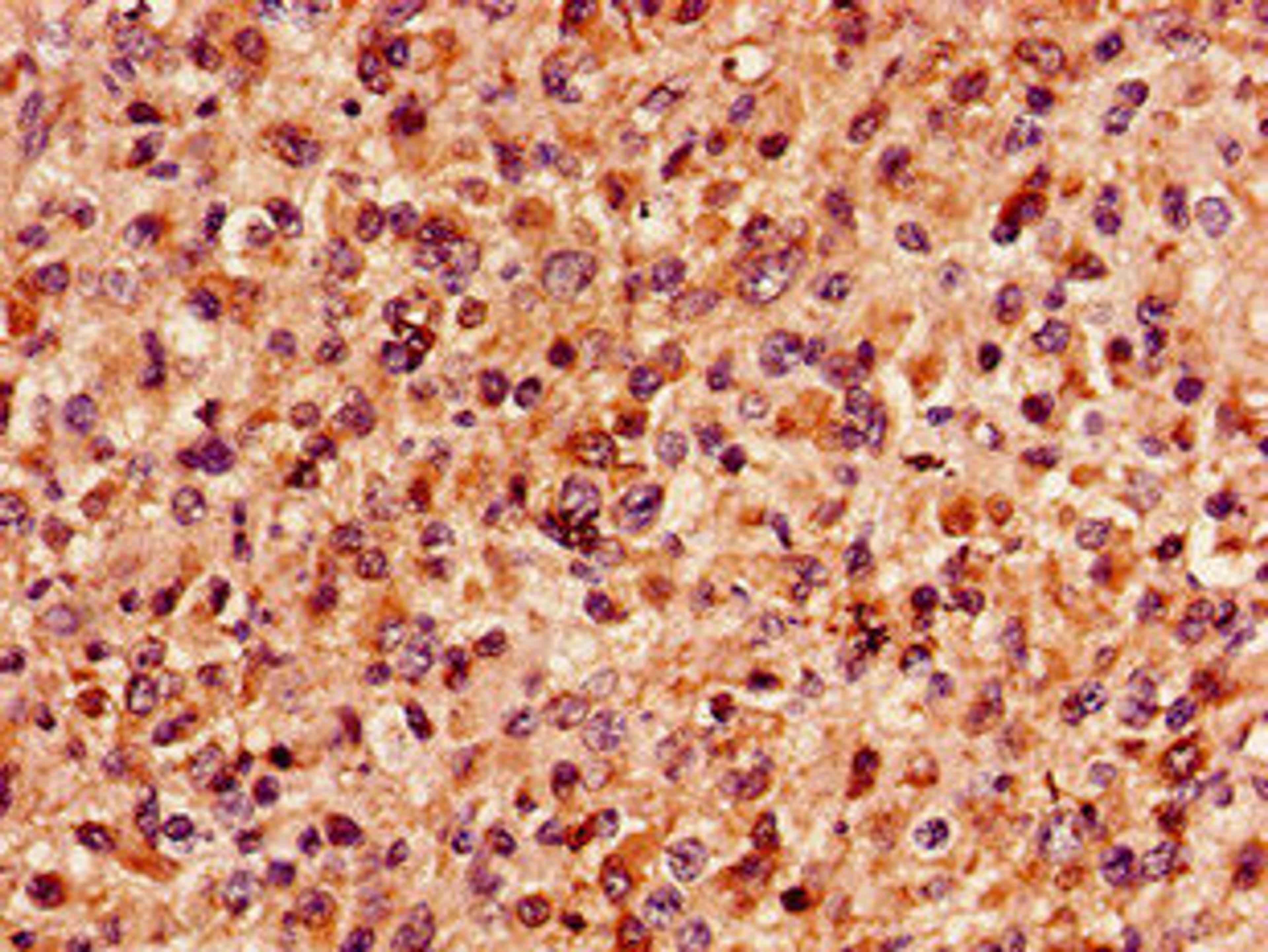 Immunohistochemistry of paraffin-embedded human glioma using CSB-PA013435LA01HU at dilution of 1:100
