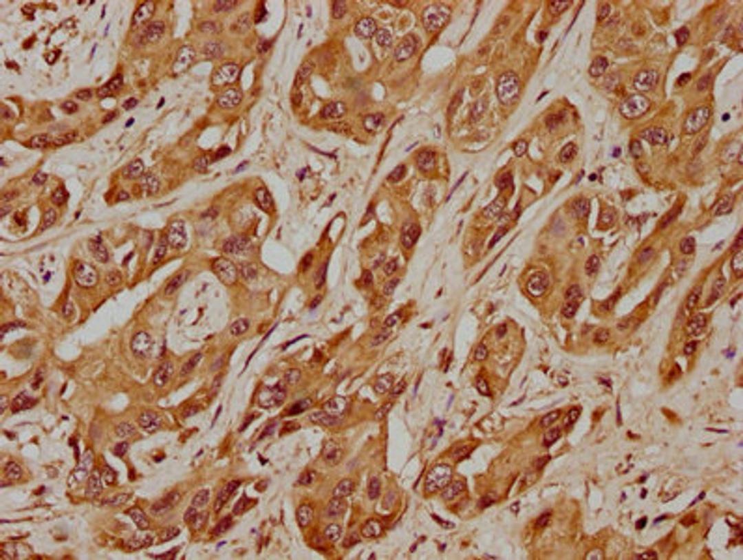 IHC image of CSB-PA427555LA01HU diluted at 1:400 and staining in paraffin-embedded human liver cancer performed on a Leica BondTM system. After dewaxing and hydration, antigen retrieval was mediated by high pressure in a citrate buffer (pH 6.0). Section was blocked with 10% normal goat serum 30min at RT. Then primary antibody (1% BSA) was incubated at 4°C overnight. The primary is detected by a biotinylated secondary antibody and visualized using an HRP conjugated SP system.
