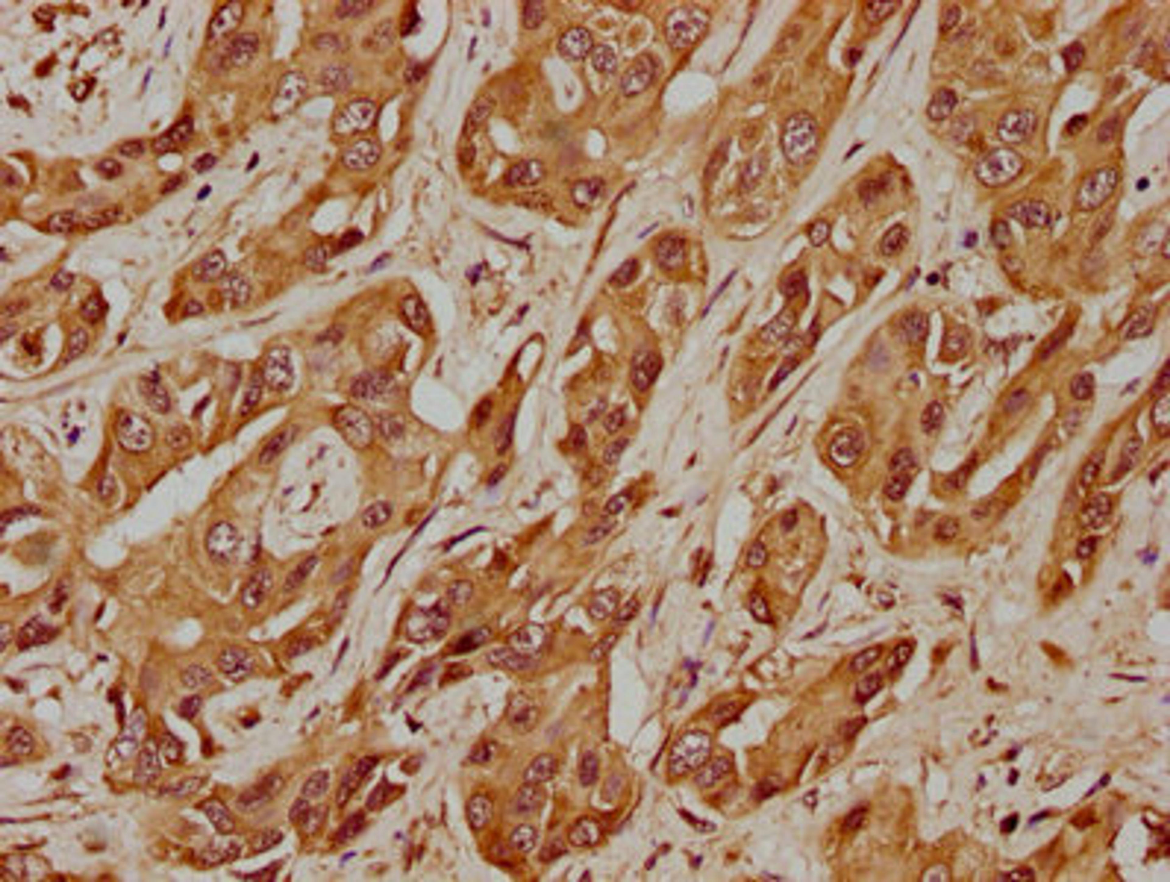 IHC image of CSB-PA427555LA01HU diluted at 1:400 and staining in paraffin-embedded human liver cancer performed on a Leica BondTM system. After dewaxing and hydration, antigen retrieval was mediated by high pressure in a citrate buffer (pH 6.0). Section was blocked with 10% normal goat serum 30min at RT. Then primary antibody (1% BSA) was incubated at 4°C overnight. The primary is detected by a biotinylated secondary antibody and visualized using an HRP conjugated SP system.
