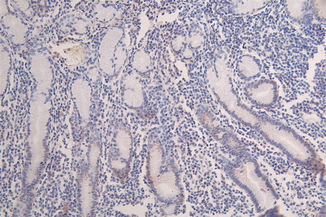 IHC image of CSB-RA547773A0HU diluted at 1:100 and staining in paraffin-embedded human breast cancer performed on a Leica BondTM system. After dewaxing and hydration, antigen retrieval was mediated by high pressure in a citrate buffer (pH 6.0). Section was blocked with 10% normal goat serum 30min at RT. Then primary antibody (1% BSA) was incubated at 4°C overnight. The primary is detected by a Goat anti-rabbit polymer IgG labeled by HRP and visualized using 0.07% DAB.