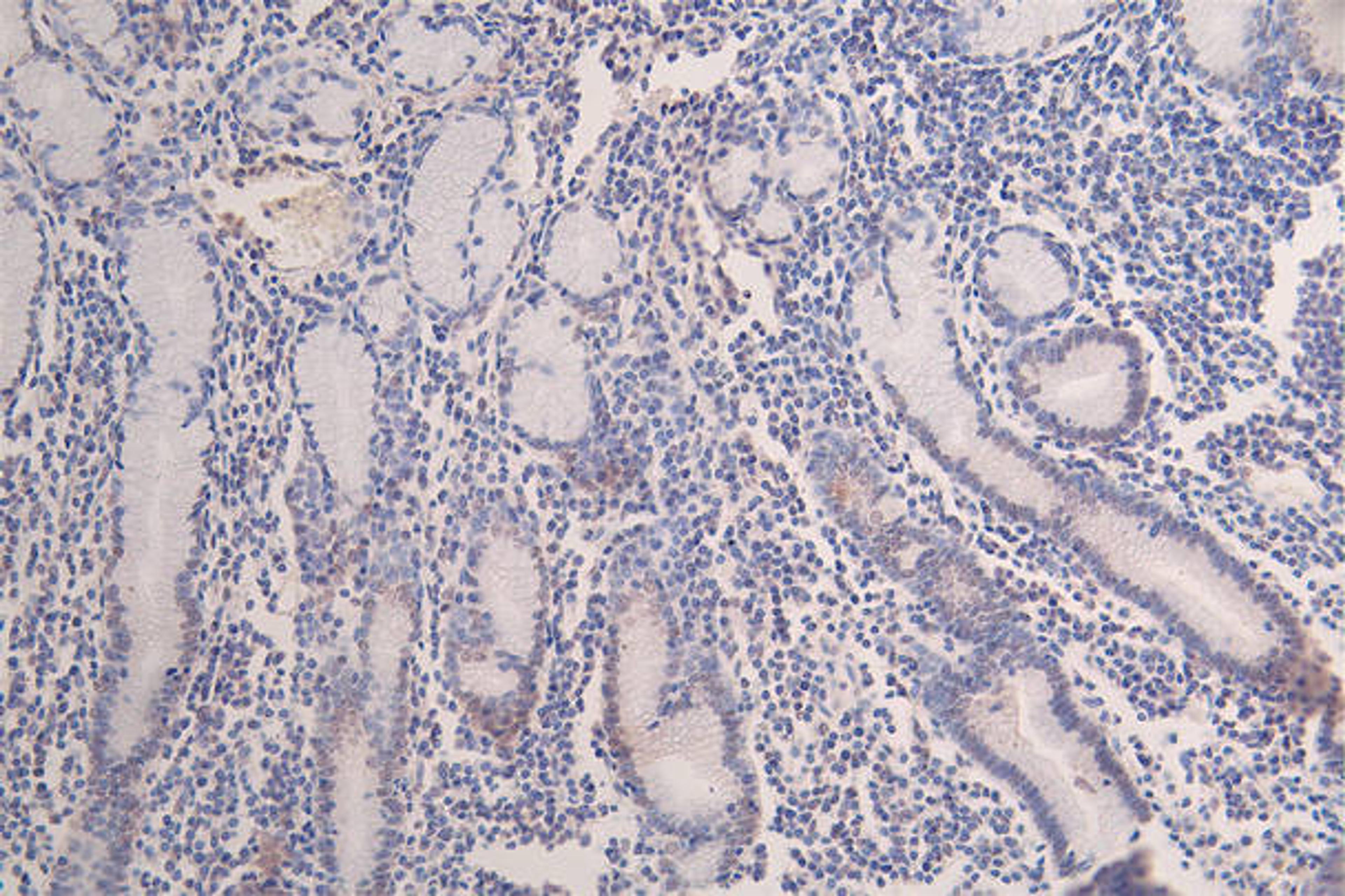 IHC image of CSB-RA547773A0HU diluted at 1:100 and staining in paraffin-embedded human breast cancer performed on a Leica BondTM system. After dewaxing and hydration, antigen retrieval was mediated by high pressure in a citrate buffer (pH 6.0). Section was blocked with 10% normal goat serum 30min at RT. Then primary antibody (1% BSA) was incubated at 4°C overnight. The primary is detected by a Goat anti-rabbit polymer IgG labeled by HRP and visualized using 0.07% DAB.