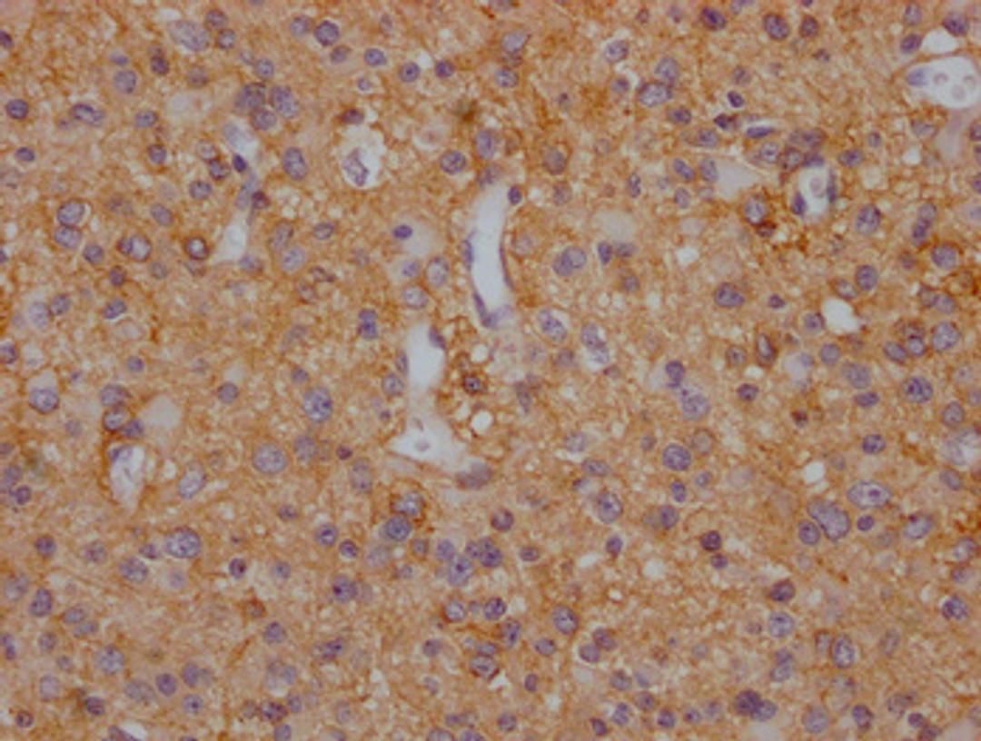 IHC image of CSB-PA021434LA11HU diluted at 1:200 and staining in paraffin-embedded human glioma cancer performed on a Leica BondTM system. After dewaxing and hydration, antigen retrieval was mediated by high pressure in a citrate buffer (pH 6.0). Section was blocked with 10% normal goat serum 30min at RT. Then primary antibody (1% BSA) was incubated at 4°C overnight. The primary is detected by a Goat anti-rabbit polymer IgG labeled by HRP and visualized using 0.05% DAB.