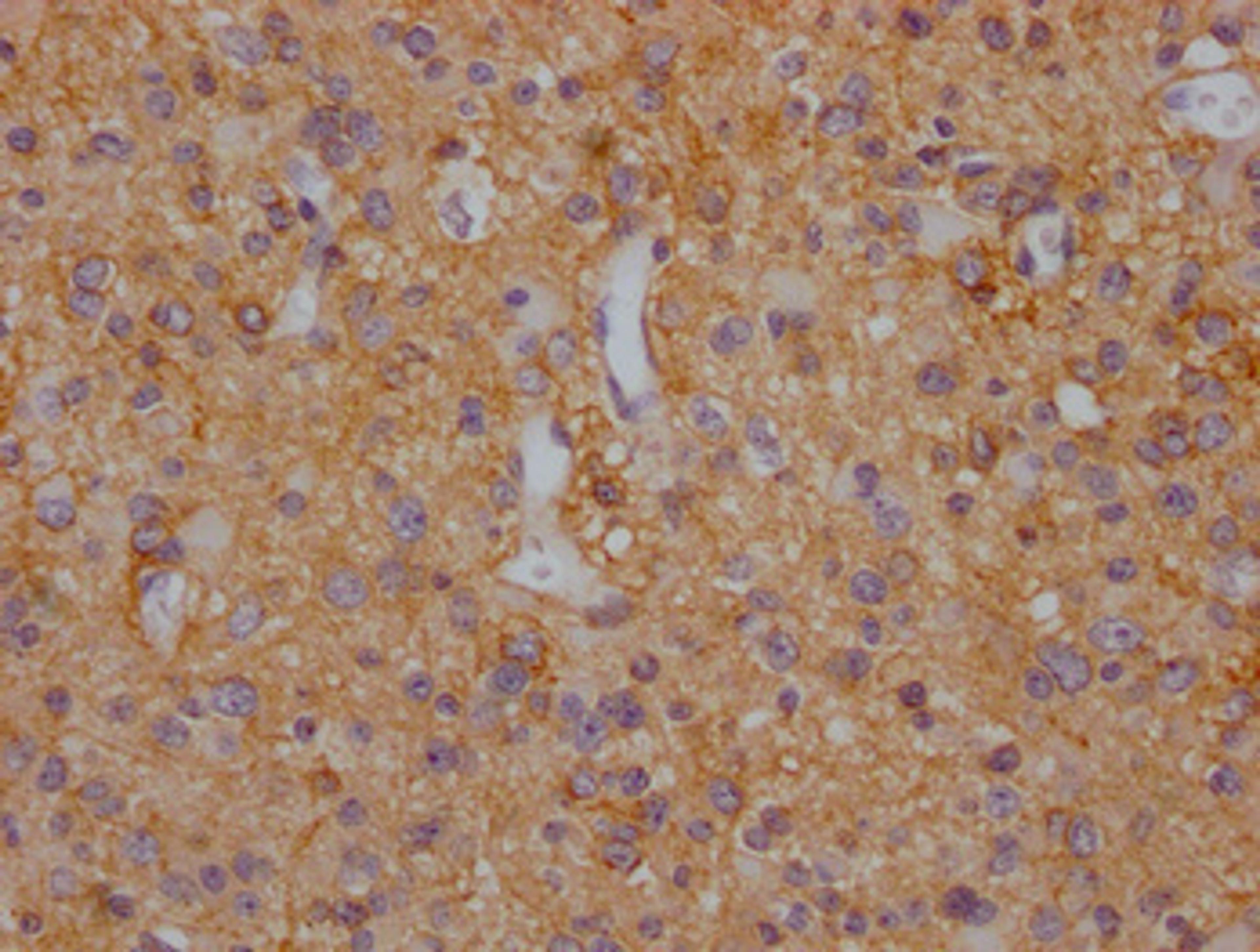 IHC image of CSB-PA021434LA11HU diluted at 1:200 and staining in paraffin-embedded human glioma cancer performed on a Leica BondTM system. After dewaxing and hydration, antigen retrieval was mediated by high pressure in a citrate buffer (pH 6.0). Section was blocked with 10% normal goat serum 30min at RT. Then primary antibody (1% BSA) was incubated at 4°C overnight. The primary is detected by a Goat anti-rabbit polymer IgG labeled by HRP and visualized using 0.05% DAB.