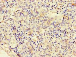 Immunohistochemistry of paraffin-embedded human lung cancer using CSB-PA822242LA01HU at dilution of 1:100