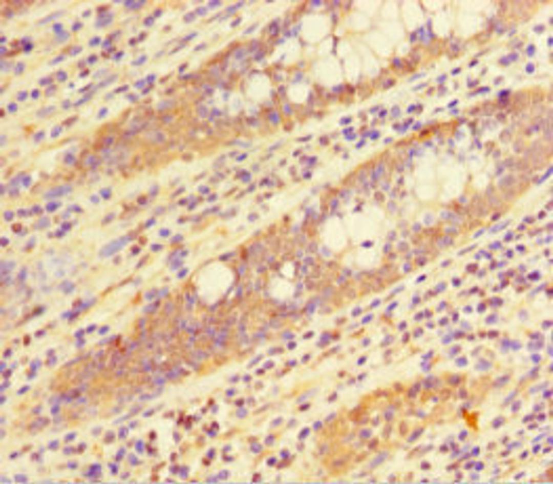 Immunohistochemistry of paraffin-embedded human colon cancer using CSB-PA010378HA01HU at dilution of 1:100