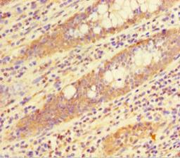 Immunohistochemistry of paraffin-embedded human colon cancer using CSB-PA010378HA01HU at dilution of 1:100