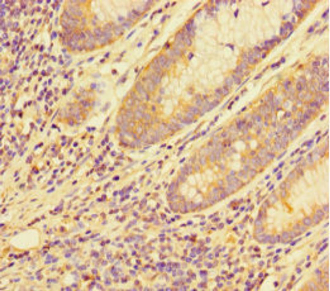 Immunohistochemistry of paraffin-embedded human colon cancer using CSB-PA862046LA01HU at dilution of 1:100