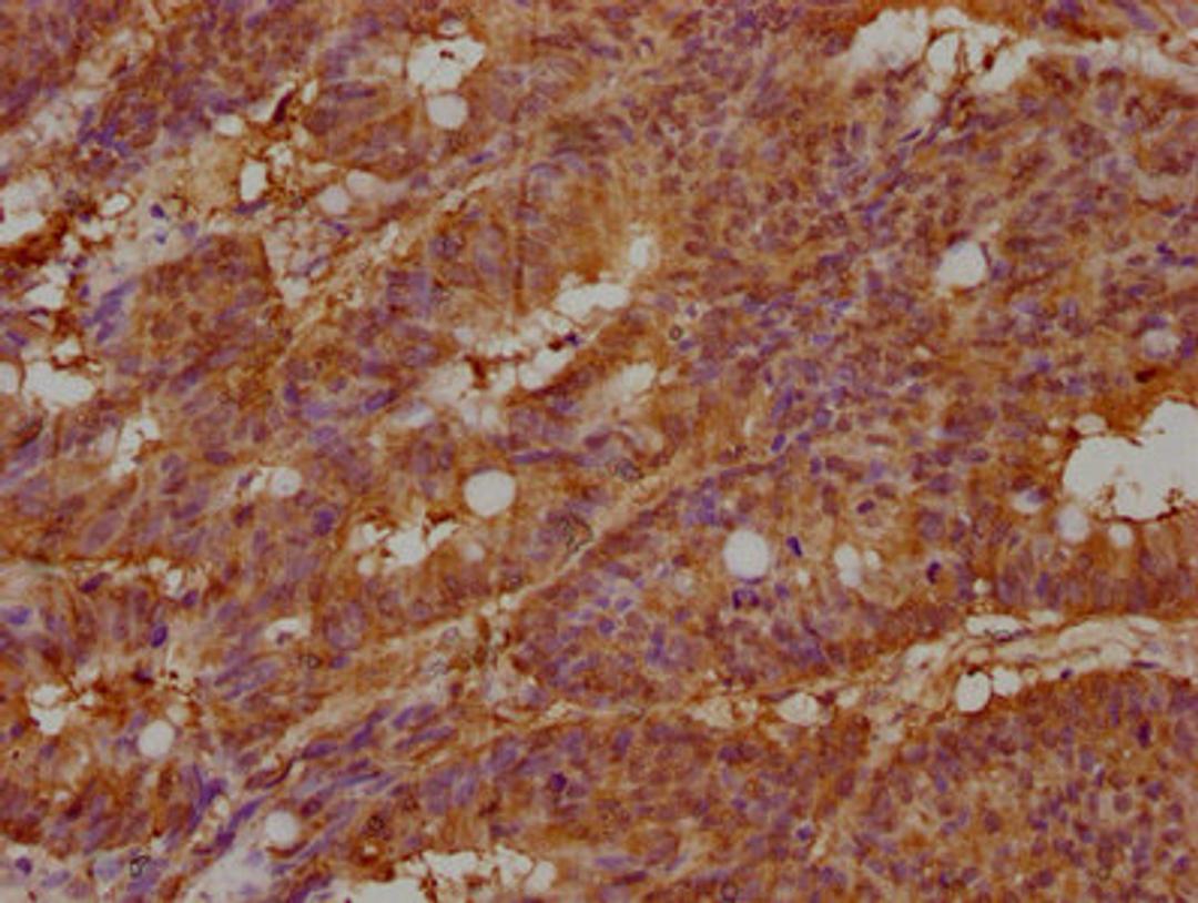 IHC image of CSB-PA011981LA01HU diluted at 1:100 and staining in paraffin-embedded human colon cancer performed on a Leica BondTM system. After dewaxing and hydration, antigen retrieval was mediated by high pressure in a citrate buffer (pH 6.0). Section was blocked with 10% normal goat serum 30min at RT. Then primary antibody (1% BSA) was incubated at 4°C overnight. The primary is detected by a biotinylated secondary antibody and visualized using an HRP conjugated SP system.