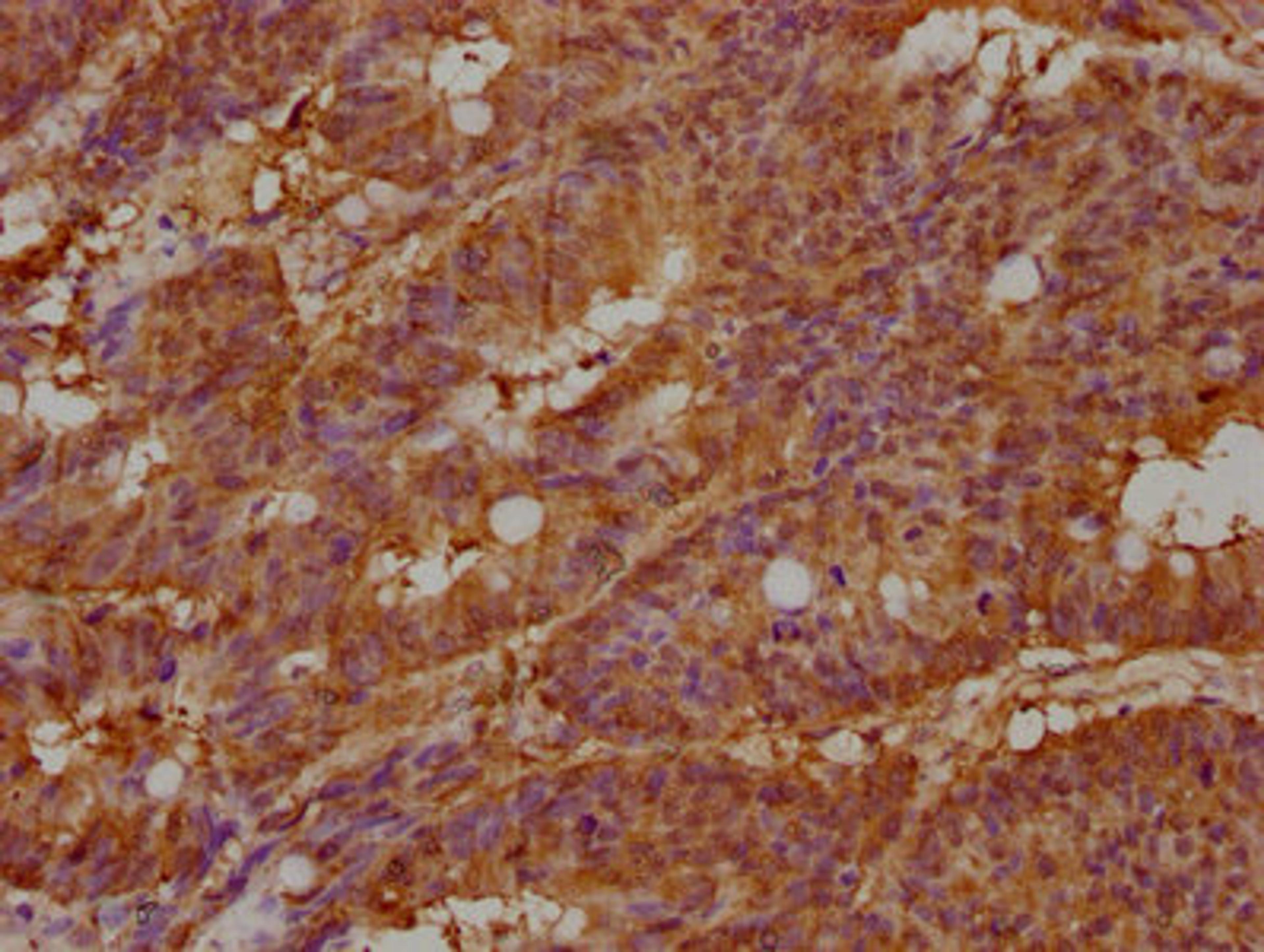 IHC image of CSB-PA011981LA01HU diluted at 1:100 and staining in paraffin-embedded human colon cancer performed on a Leica BondTM system. After dewaxing and hydration, antigen retrieval was mediated by high pressure in a citrate buffer (pH 6.0). Section was blocked with 10% normal goat serum 30min at RT. Then primary antibody (1% BSA) was incubated at 4°C overnight. The primary is detected by a biotinylated secondary antibody and visualized using an HRP conjugated SP system.