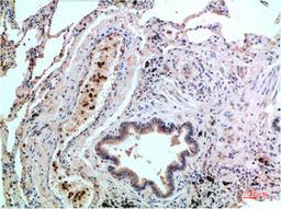 Immunohistochemical analysis of paraffin-embedded Human Lung Carcinoma Tissue using P38  Mouse mAb diluted at 1:200.