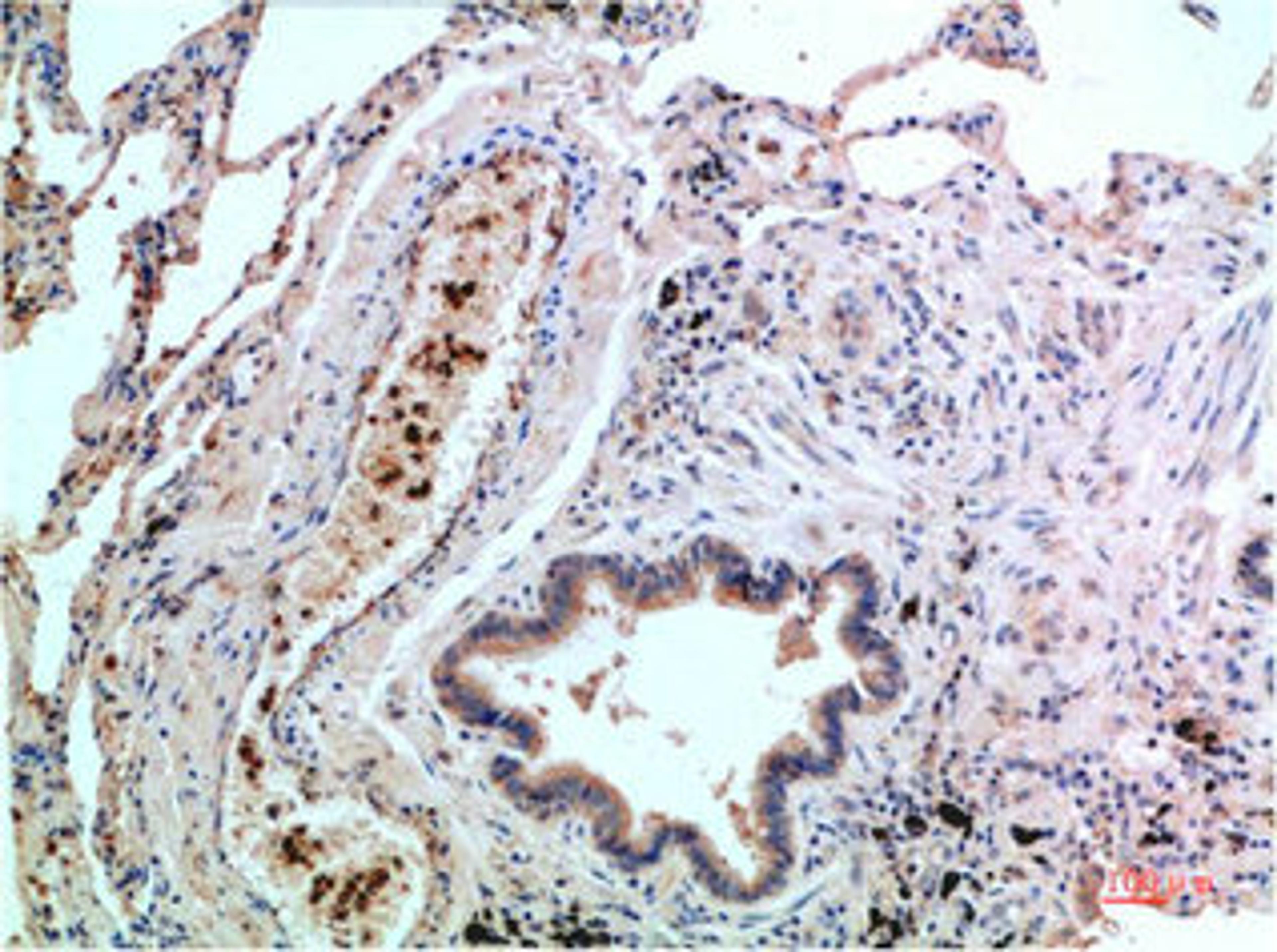 Immunohistochemical analysis of paraffin-embedded Human Lung Carcinoma Tissue using P38  Mouse mAb diluted at 1:200.