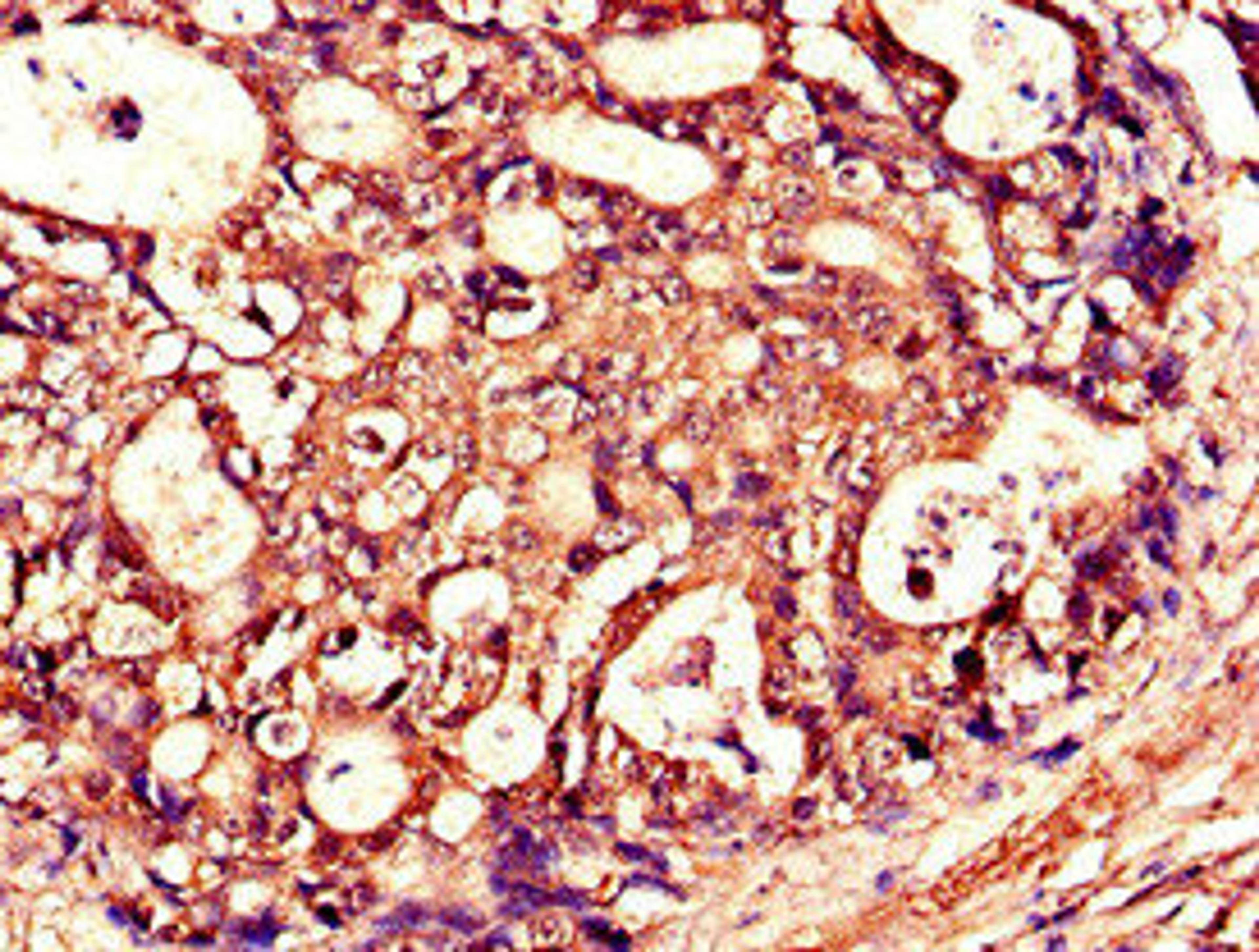 Immunohistochemistry of paraffin-embedded human gastric cancer using CSB-PA023986LA01HU at dilution of 1:100