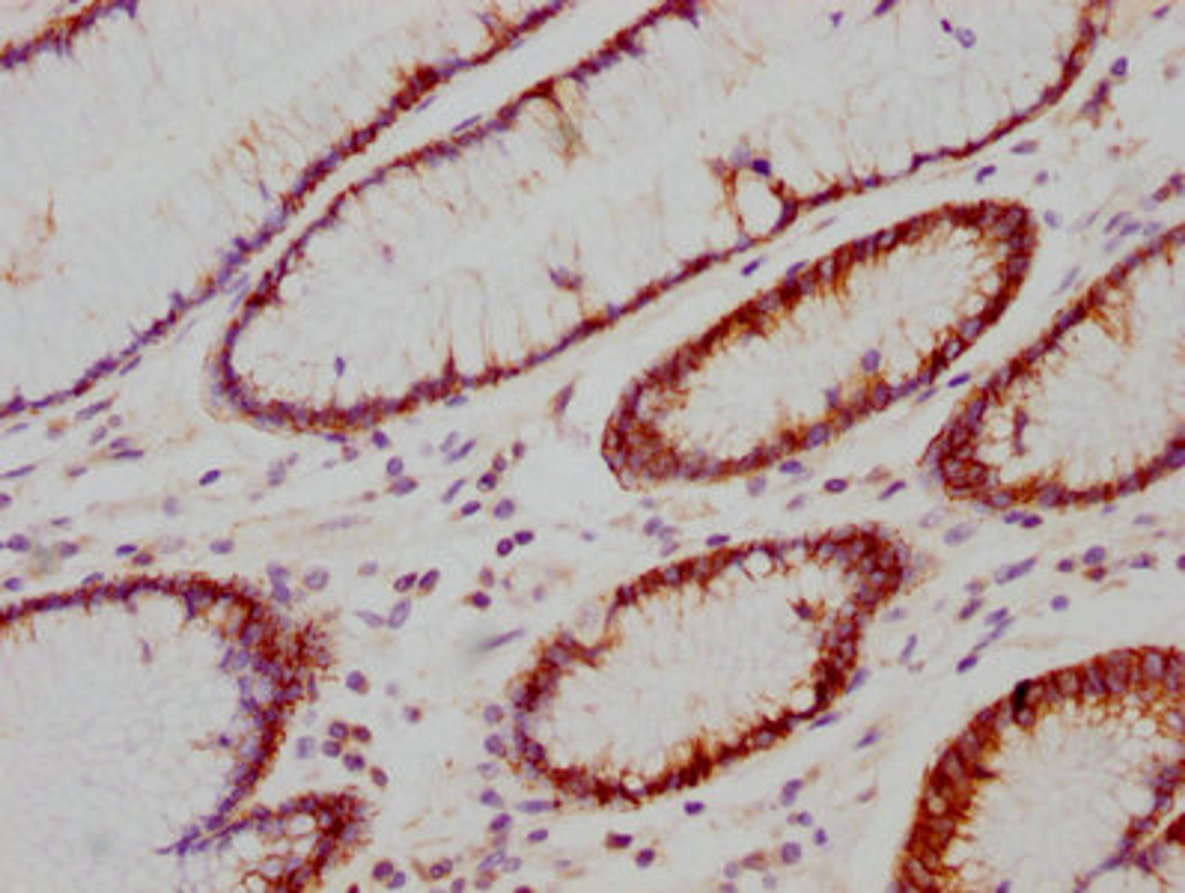 IHC image of CSB-RA614990A0HU diluted at 1:118 and staining in paraffin-embedded human gastric cancer performed on a Leica BondTM system. After dewaxing and hydration, antigen retrieval was mediated by high pressure in a citrate buffer (pH 6.0). Section was blocked with 10% normal goat serum 30min at RT. Then primary antibody (1% BSA) was incubated at 4℃ overnight. The primary is detected by a biotinylated secondary antibody and visualized using an HRP conjugated SP system.