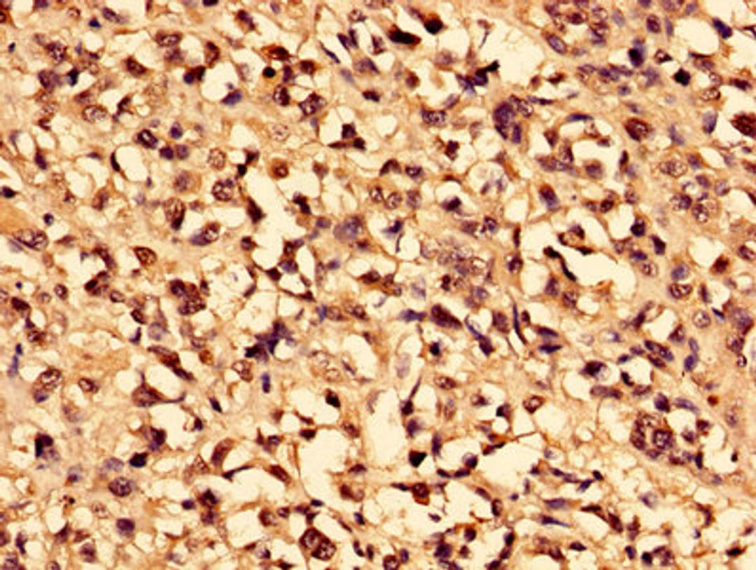 Immunohistochemistry of paraffin-embedded human melanoma using CSB-PA004364HA01HU at dilution of 1:100