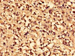 Immunohistochemistry of paraffin-embedded human melanoma using CSB-PA004364HA01HU at dilution of 1:100