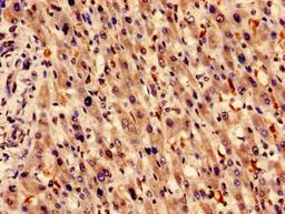Immunocytochemistry analysis of human liver cancer using CSB-PA010583LA01HU at dilution of 1:100