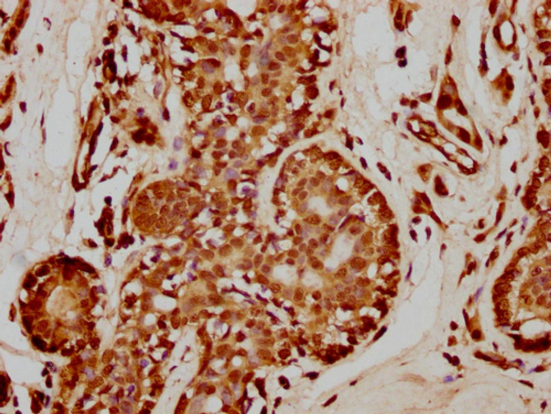 IHC image of CSB-PA010429PA35nme1HU diluted at 1:50 and staining in paraffin-embedded human breast cancer performed on a Leica BondTM system. After dewaxing and hydration, antigen retrieval was mediated by high pressure in a citrate buffer (pH 6.0). Section was blocked with 10% normal goat serum 30min at RT. Then primary antibody (1% BSA) was incubated at 4°C overnight. The primary is detected by a biotinylated secondary antibody and visualized using an HRP conjugated SP system.