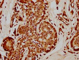 IHC image of CSB-PA010429PA35nme1HU diluted at 1:50 and staining in paraffin-embedded human breast cancer performed on a Leica BondTM system. After dewaxing and hydration, antigen retrieval was mediated by high pressure in a citrate buffer (pH 6.0). Section was blocked with 10% normal goat serum 30min at RT. Then primary antibody (1% BSA) was incubated at 4°C overnight. The primary is detected by a biotinylated secondary antibody and visualized using an HRP conjugated SP system.