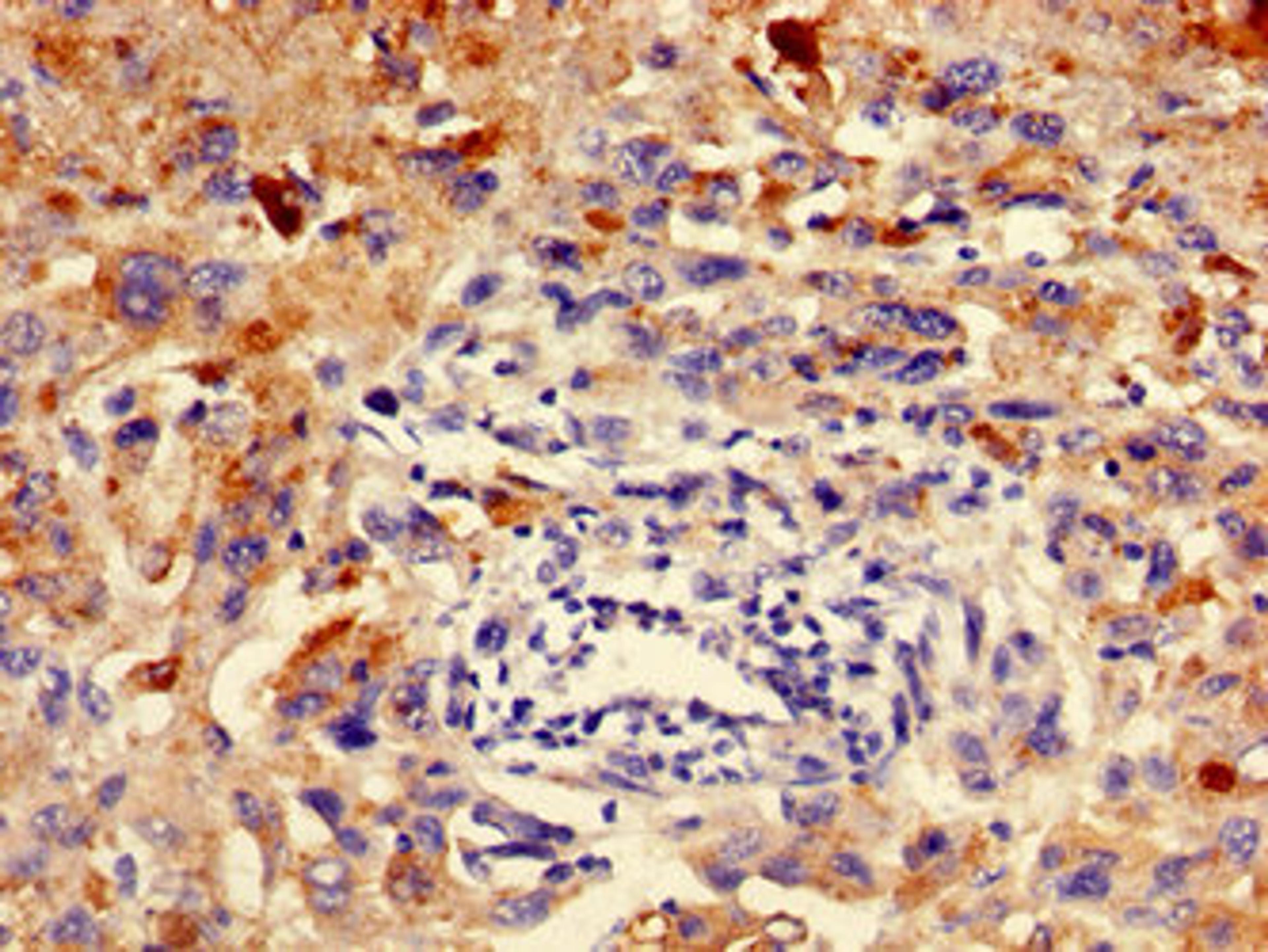 Immunohistochemistry of paraffin-embedded human melanoma using CSB-PA846590LA01HU at dilution of 1:100