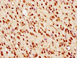 IHC image of CSB-PA010389PA36nsucHU diluted at 1:10 and staining in paraffin-embedded human glioma cancer performed on a Leica BondTM system. After dewaxing and hydration, antigen retrieval was mediated by high pressure in a citrate buffer (pH 6.0). Section was blocked with 10% normal goat serum 30min at RT. Then primary antibody (1% BSA) was incubated at 4°C overnight. The primary is detected by a biotinylated secondary antibody and visualized using an HRP conjugated SP system.
