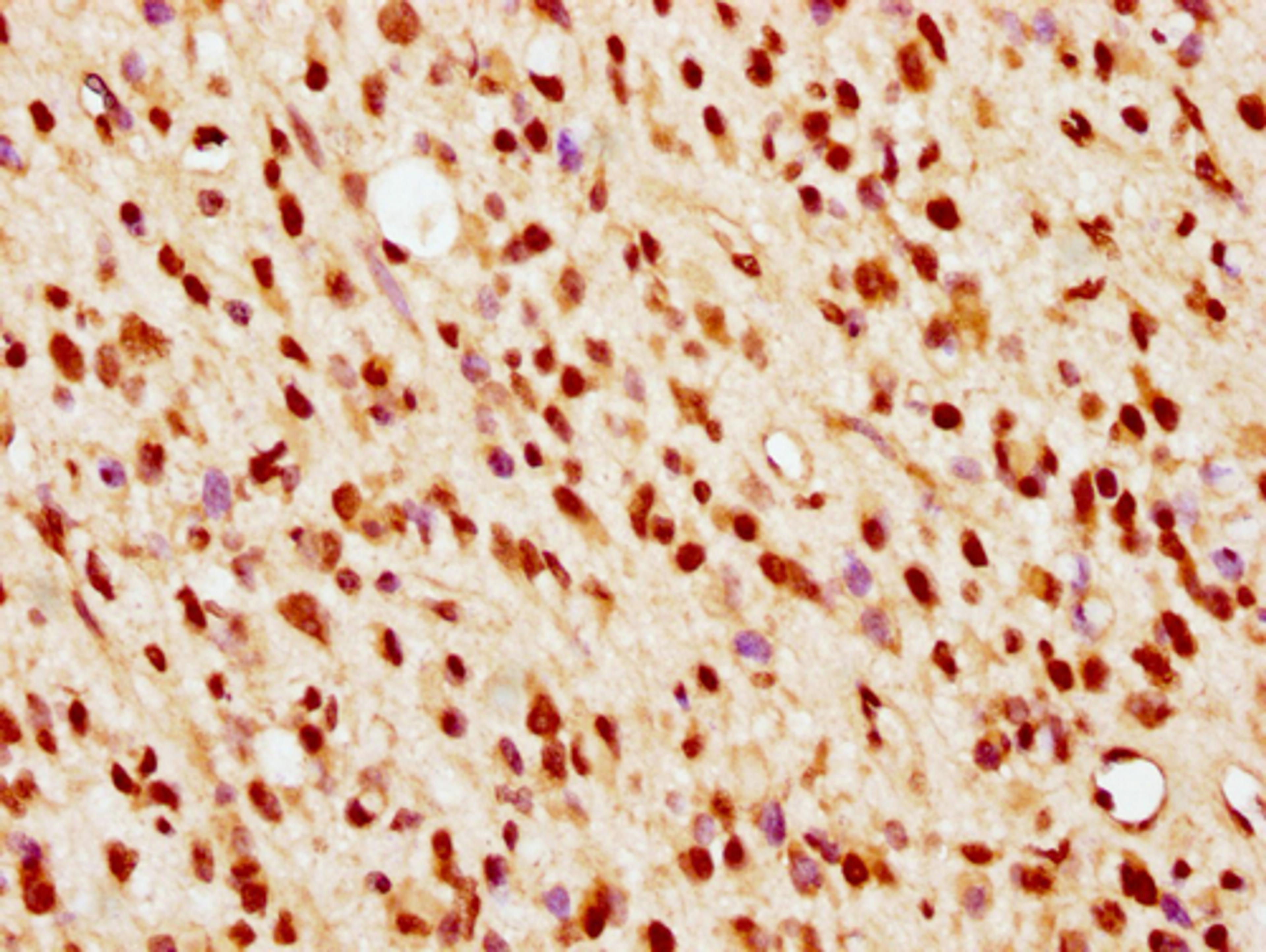 IHC image of CSB-PA010389PA36nsucHU diluted at 1:10 and staining in paraffin-embedded human glioma cancer performed on a Leica BondTM system. After dewaxing and hydration, antigen retrieval was mediated by high pressure in a citrate buffer (pH 6.0). Section was blocked with 10% normal goat serum 30min at RT. Then primary antibody (1% BSA) was incubated at 4°C overnight. The primary is detected by a biotinylated secondary antibody and visualized using an HRP conjugated SP system.