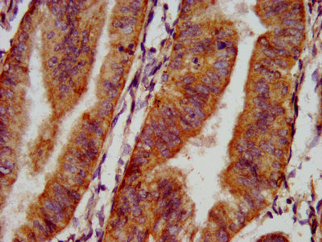 IHC image of CSB-PA015987LA01HU diluted at 1:500 and staining in paraffin-embedded human endometrial cancer performed on a Leica BondTM system. After dewaxing and hydration, antigen retrieval was mediated by high pressure in a citrate buffer (pH 6.0). Section was blocked with 10% normal goat serum 30min at RT. Then primary antibody (1% BSA) was incubated at 4&deg;C overnight. The primary is detected by a biotinylated secondary antibody and visualized using an HRP conjugated SP system.