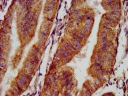 IHC image of CSB-PA015987LA01HU diluted at 1:500 and staining in paraffin-embedded human endometrial cancer performed on a Leica BondTM system. After dewaxing and hydration, antigen retrieval was mediated by high pressure in a citrate buffer (pH 6.0). Section was blocked with 10% normal goat serum 30min at RT. Then primary antibody (1% BSA) was incubated at 4&deg;C overnight. The primary is detected by a biotinylated secondary antibody and visualized using an HRP conjugated SP system.